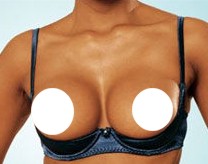 breast-lift-bra.jpg